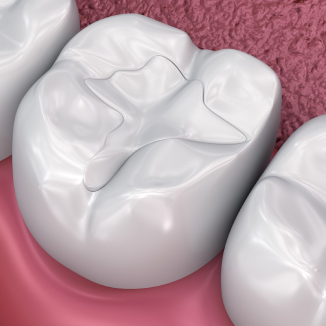 Tooth-Colored Dental Fillings in in Modesto, CA