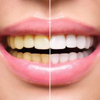 Before & After Teeth Whitening in Modesto, CA