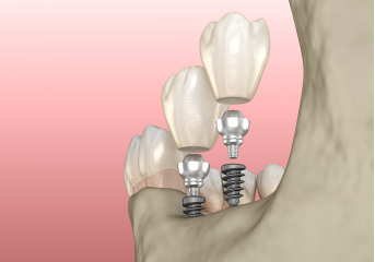 Mini Dental Implants in Modesto, CA 