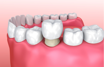 Dental Crowns in Irvine - Irvine CA Tooth Crowns - Teeth Caps Irvine  California