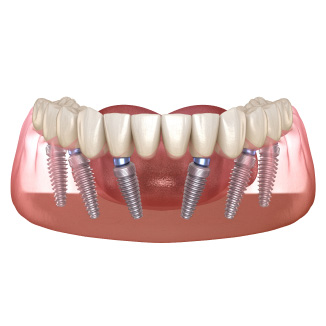 3 on 6 Dental Implants in Modesto, CA