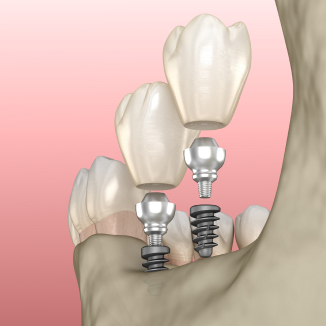Mini Dental Implants in Modesto, CA