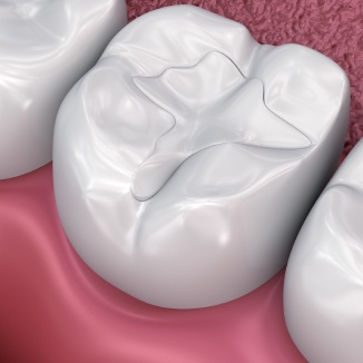 Tooth Colored Dental Fillings